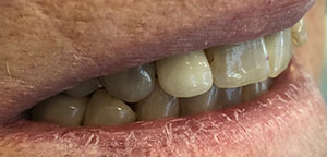 Before Dental Treatment 2