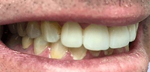 After Dental Treatment 3