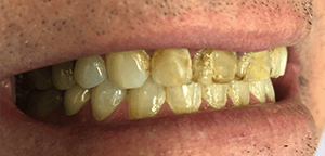 Before Dental Treatment 3