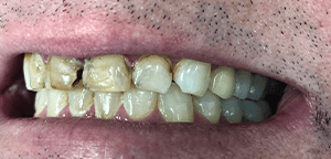 Before Dental Treatment 2