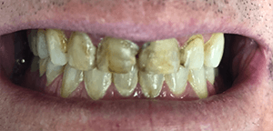 Before Dental Treatment 1