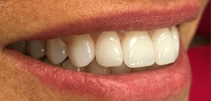 After Dental Treatment 2
