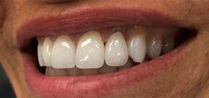 After Dental Treatment 1