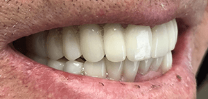 After Dental Treatment 1