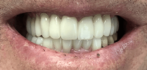 After Dental Treatment 3